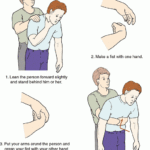 Heimlich Maneuver Causes Symptoms Treatment Heimlich Maneuver