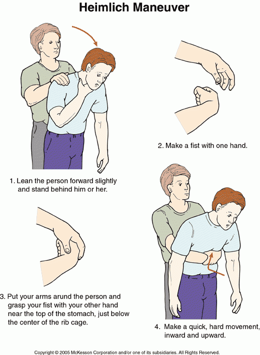 Heimlich Maneuver Causes Symptoms Treatment Heimlich Maneuver